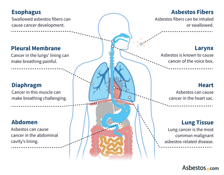 Maladies liées à l'amiante